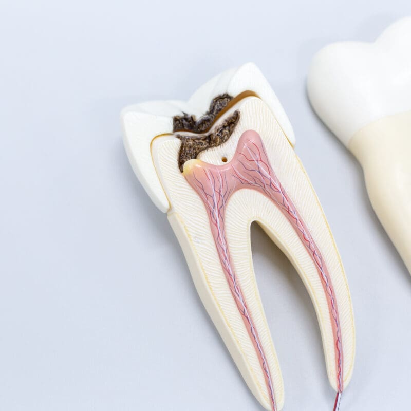 root canals in Coeur d'Alene