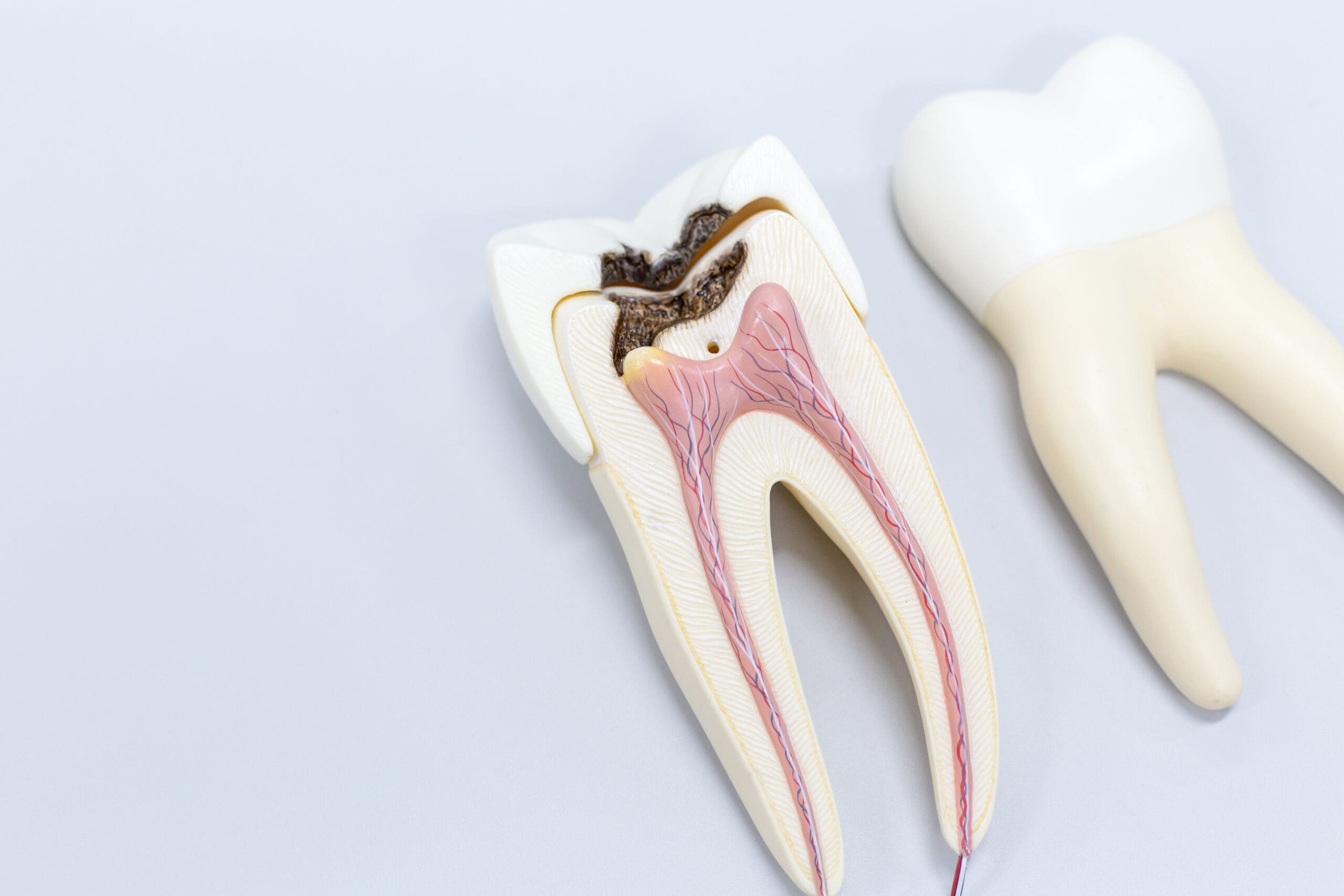 root canals in Coeur d'Alene